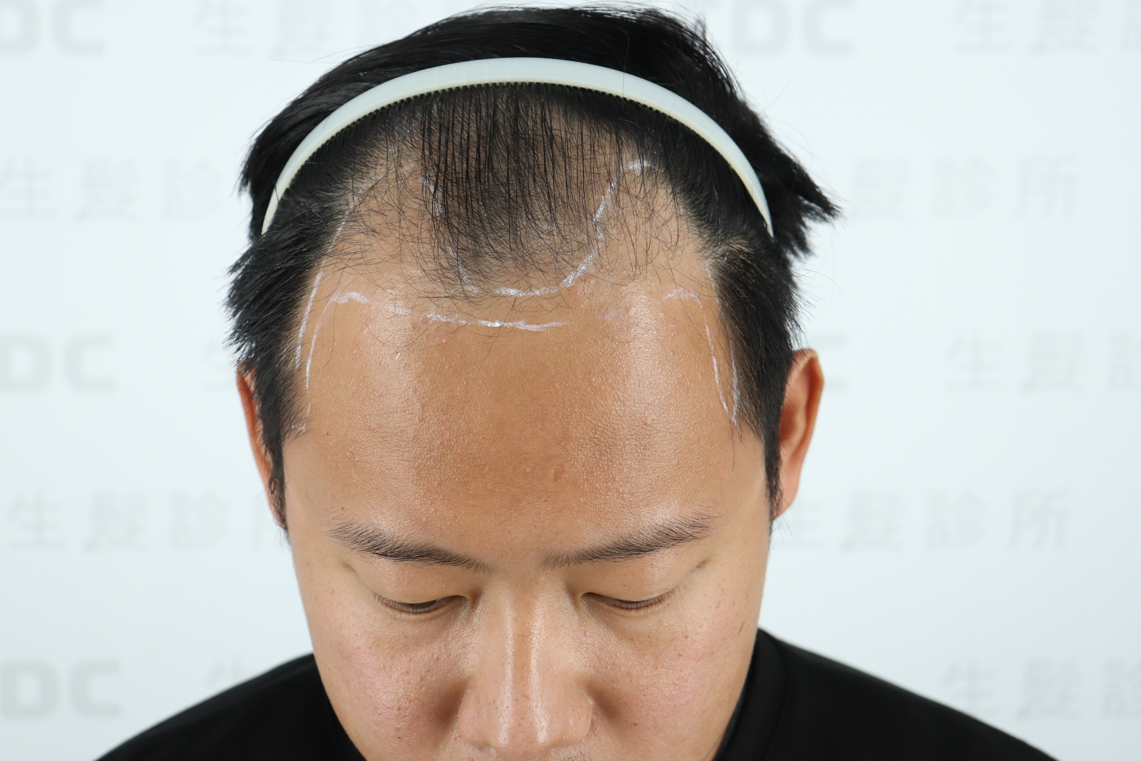 DCDC生髮診所-黃于甄醫師男性大面積M型禿植髮術前評估